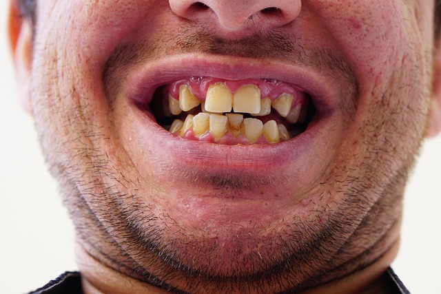 Myter og fakta om invisalign: Hvad bør du vide før behandling i københavn?